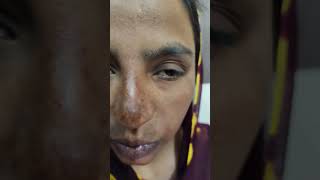 Melasma Chloasma Treatment Dr Ahsan Ahmad Skin Care Clinic Call 91 7417928805 [upl. by Dripps]