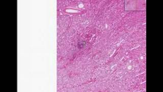 Histopathology KidneyBacterial endocarditis [upl. by Estrellita]