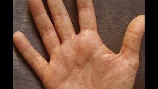 Dermatitis or Dyshidrosis How I Prevent Getting Painful And Unsightly Summer Hands [upl. by Mientao]