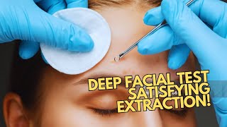 Satisfying Deep Facial Extraction Moments  Professional Review  Skin Extraction  Pores Cleaning [upl. by Nawaj]