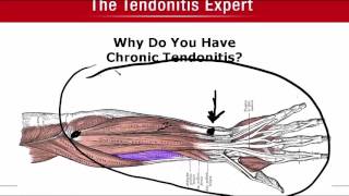 Why Do You Have Chronic Tendonitis [upl. by Adnorahc931]