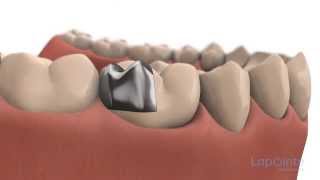 Inlays and onlays  Lapointe dental centres [upl. by Weinman181]