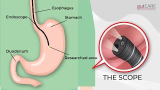 Preparing For Your Gastroscopy OGD  GUTCARE [upl. by Audi]