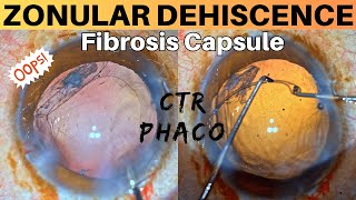 Zonular Dehiscence Noted during Phacoemulsification Management strategies  Dr Deepak Megur [upl. by Barra]