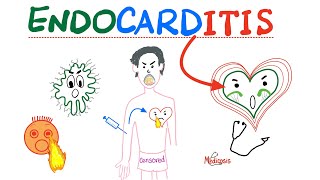 Infective Endocarditis  Fever amp New Murmur  Modified Duke’s Criteria  Cardiology Playlist [upl. by Uttasta605]