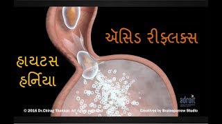 એસિડ રિફ્લક્સ એસિડીટી હાયેટ્સ હર્નિયા અને GERD વિશે સંપૂર્ણ જાણકારી  અમદાવાદ [upl. by Montagna]