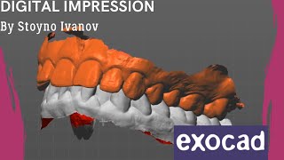 How To Design A Case With Digital Impression Intraoral Scanner EXOCAD [upl. by Limber]