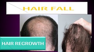 minoxidil and Finasteride hair regrowth reviewHair regrowth कैसे करेंminoxidil finasteride [upl. by Barrus733]