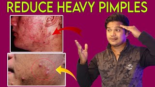 REDUCE HEAVY AND BIG PIMPLES ON FACE 😭  Telugu  No More Big Pimples [upl. by Bowrah813]