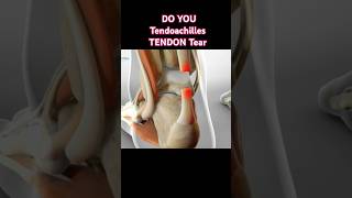 Learn about Tendon Tear tips foryou exercises physiotherapy physiotherapist doctor heelpain [upl. by Aiken]