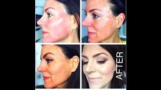 TCA CHEMICAL PEEL 25  Application Tutorial [upl. by Oconnor]