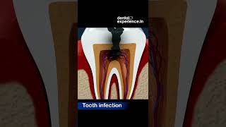 Tooth infection  Abscess  Caries  Symptoms  Treatments  Dentalexperiencein [upl. by Woodley]