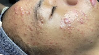 ACNE TREATMENT VU QUYNH MI Acne On Boys Cheek 2024 [upl. by Boleyn]