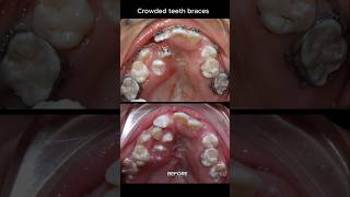 The most crowded teeth ive ever seen braces orthodontist dentist [upl. by Relyhcs]