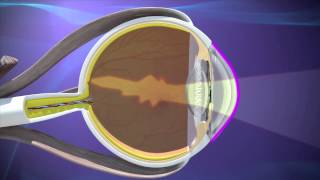 Astigmatism Treatment amp Surgery Atlanta GA [upl. by Stephana]