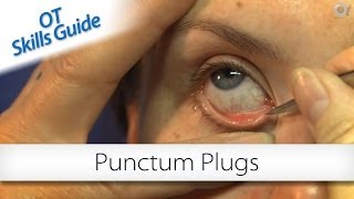 OT skills guide punctum plugs [upl. by Nataniel931]