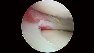 R knee chondroplasty and 6 22 23 VB [upl. by Ayalat]