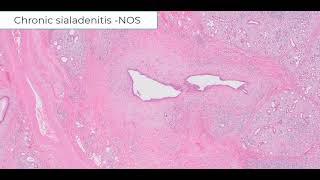 Chronic sialadenitis not otherwise specfied [upl. by Millman]