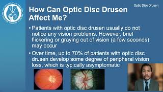 Optic Disc Drusen [upl. by Durrett]