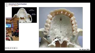 02 maxillary palatal infiltration anesthetic technique [upl. by Lrigybab942]