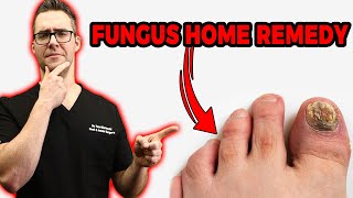 20 Ways To Get Rid of Toenail Fungus Proven CURE amp Home Remedies [upl. by Xuerd]