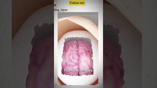 Craniectomy Brain Surgery Explained 🧠 shorts [upl. by Myer]