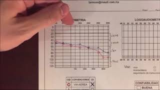 Video de como interpretar una audiometría [upl. by Jemmy]