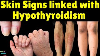 Skin Signs linked with Hypothyroidism Underactive Thyroid [upl. by Erehc370]