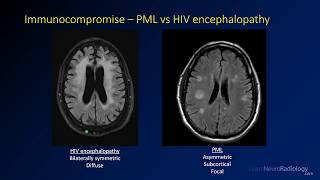 Intracranial infections  4  Immunocompromise [upl. by Nirik]