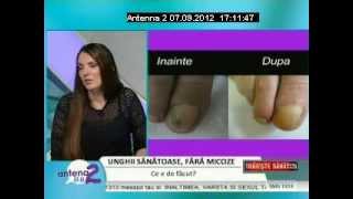 Tratamentul Onicomicozei Micoza Unghiei cu LaserulFormatk  Traieste sanatos Antena 2 [upl. by Sissie]