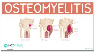 Osteomyelitis Classification Causes Pathophysiology Signs and Symptoms Diagnosis and Treatment [upl. by Argus]