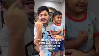 Pityriasis Alba Dr imran Patel official drimranpatel babydocter shorts [upl. by Attenev]