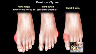 Bunions Types  Everything You Need To Know  Dr Nabil Ebraheim [upl. by Evanthe]