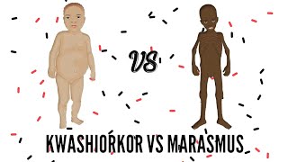 SAM  Severe Acute Malnutrition  Kwashiorkor VS Marasmus [upl. by Theodor]