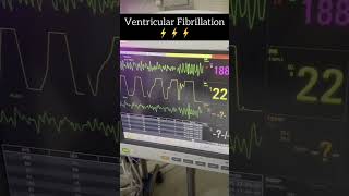 Ventricular fibrillationventricular fibrillationmedicaleducation medicalcollegestudents [upl. by Airdnala]