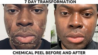 CHEMICAL PEEL ON BLACK SKIN  FULL PROCESS BEFORE amp AFTER  HYPERPIGMENTATION amp DARK SPOTS [upl. by Matlick]