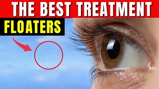 How to Get Rid of Eye Floaters  Eye Floaters Best Natural Treatment [upl. by Banquer942]