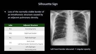 How to Interpret a Chest XRay Lesson 8  Focal Lung Processes [upl. by Lajib]