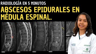 Radiología en 5 minutos Abscesos epidurales en médula espinal [upl. by Yahsat512]