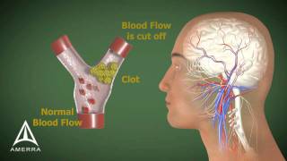 Stroke  3D Medical Animation [upl. by Swirsky]