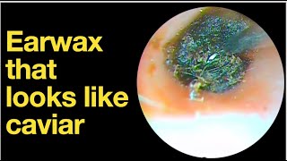 Earwax that looks like caviar ear wax removal  ear cleaning  ASMR  relaxation  relax [upl. by Allare538]