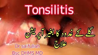 homeopathic medicine for tonsillitis gale k ghadood ka ilaj in urdu hindi tonsil ka ilaj [upl. by Krenek]