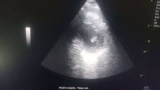 HYPOKINESIA OF ANTERO SEPTUM APICAL SEPTUM APEX AND ANTEROLATERAL MODERATE LV [upl. by Noiz]