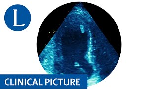 Takotsubo cardiomyopathy in a patient with Lynch syndrome [upl. by Esinaej480]