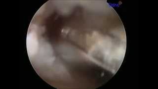 HIP ARTHROSCOPY BONEGRAFTING AN ACETABULUM CYST DR ROBERT RUPP [upl. by Aicrag]