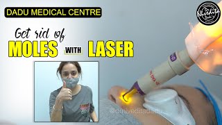 Laser Mole Removal  Get rid of moles with laser  Procedure Video [upl. by Manville]