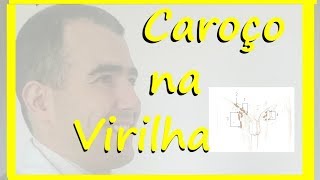 Caroço na virilha doutor estou preocupado [upl. by Raseta]