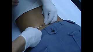 Perforación  Piercing surface en la espalda [upl. by Ilojne]