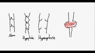 Lymphdrainage Theorie Primäres und Sekudäres Lymphödem [upl. by Alaric]