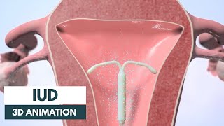 How does an IUD work  3D animation [upl. by Avika265]